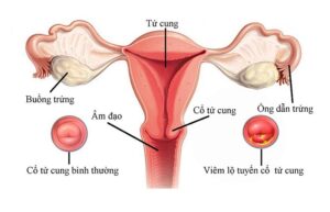 viêm lộ tuyến cổ tử cung