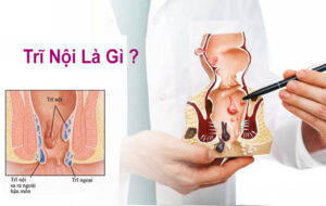 bệnh trĩ là gì