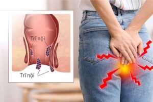 cách điều trị bệnh trĩ nội độ 2
