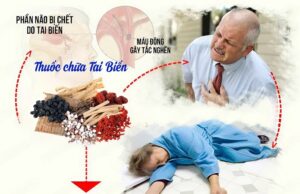 Bài thuốc chữa tai biến bằng Đông y hiệu quả ngay tại nhà