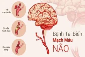 dấu hiệu tai biến mạch máu não