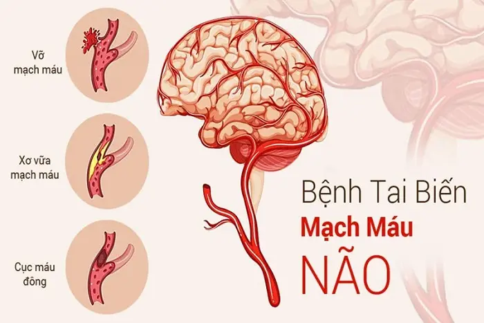 dấu hiệu tai biến mạch máu não